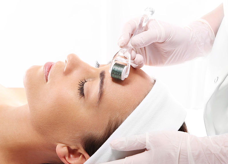 micro needling