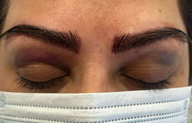 eyebrow transplant after