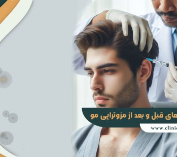 مراقبت های قبل و بعد از مزوتراپی مو