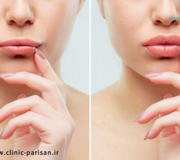 care after lip fillers