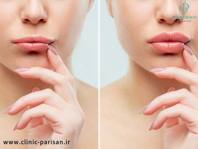 care after lip fillers